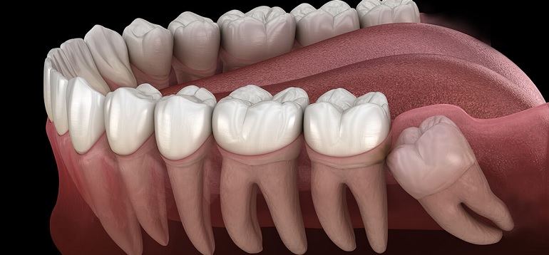 Wisdom Tooth Removal in Seawood